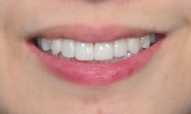 Laminate Veneers for Protruding Teeth: If They’re Too Thick, They Look Even More Prominent image 13