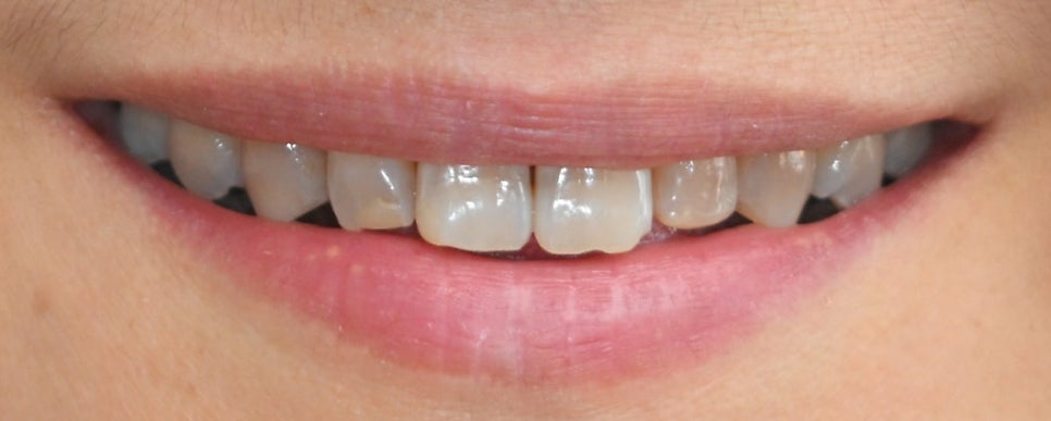 Objet Laminate Treatment for Seniors: Naturally Beautiful, Without Tooth Reduction image 5
