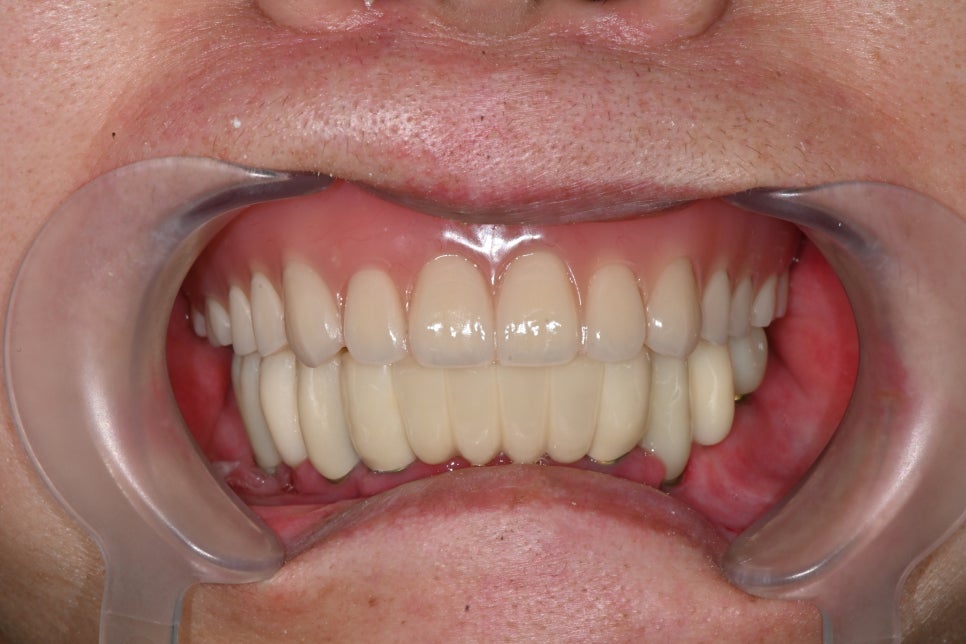 How Are Snap-On Dentures and Full-Mouth Implant Costs Handled at an Implant Dental Clinic? image 13
