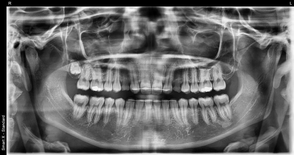 Minimally Invasive Laminate Veneers, Simultaneous Tooth Shaping with Obezero Laminate image 4