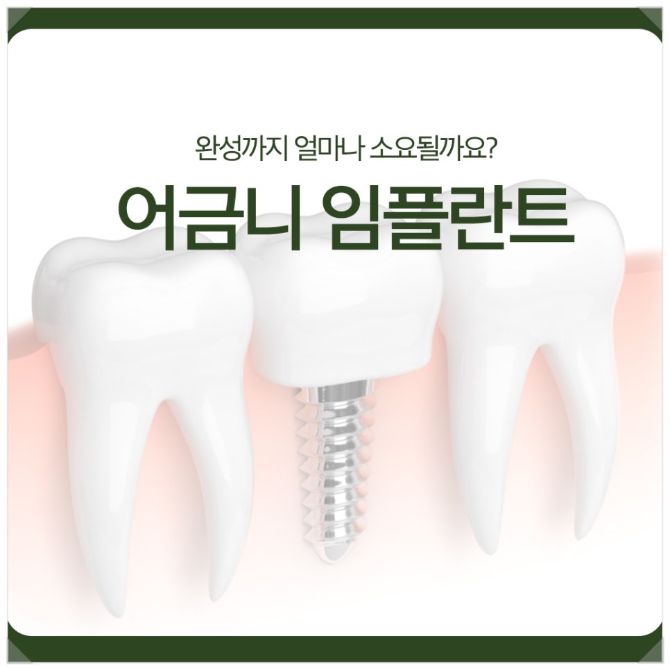 어금니 임플란트, 완성까지 얼마나 소요될까요? 관련 이미지 1