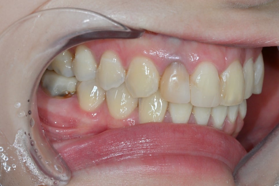 Discolored Front Teeth: Are Crowns the Only Answer? image 4