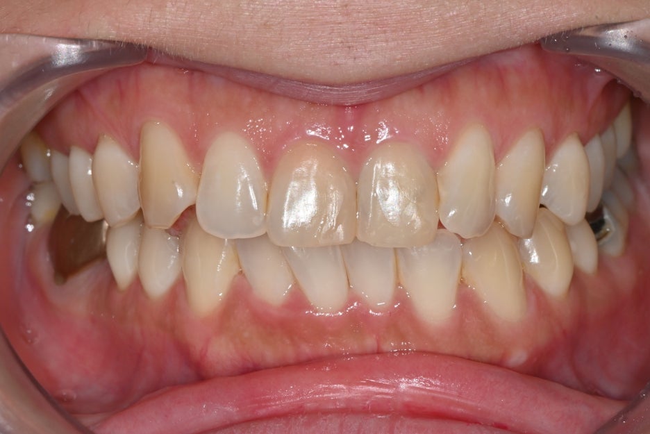 Laminates Price, Zero-Reduction Laminates with Ovzero image 3