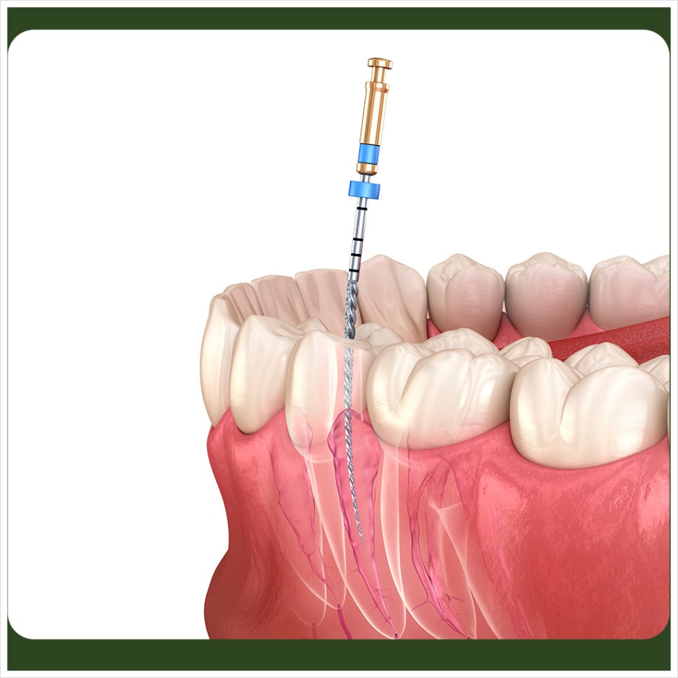 Stopping Root Canal Treatment Is Not Okay — You Must Finish It to the End! image 3