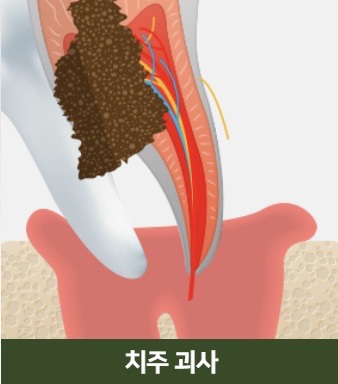 The Power to Protect Natural Teeth: Seoul Orbe Dental Hospital’s Philosophy of Conservative Treatment image 6