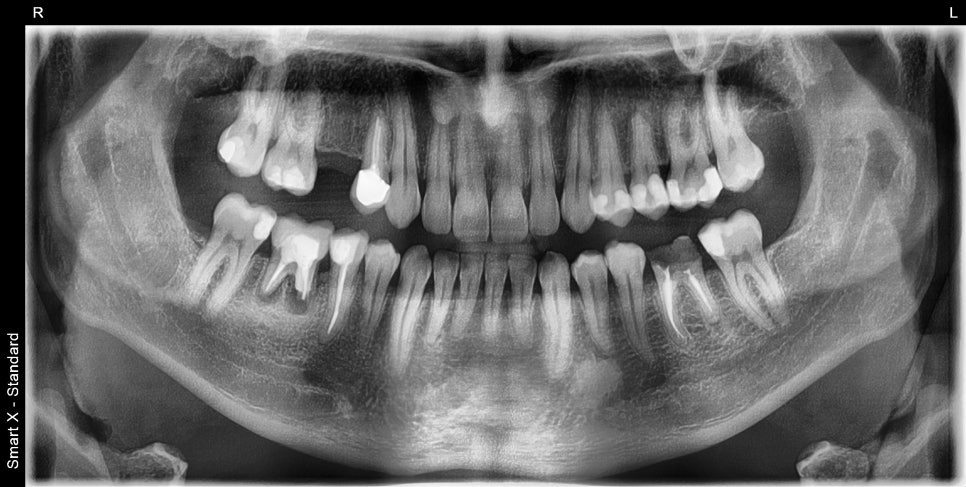 Implant Treatment Available for Foreign Residents Abroad! A Case Completed Perfectly Within 3 Months image 1