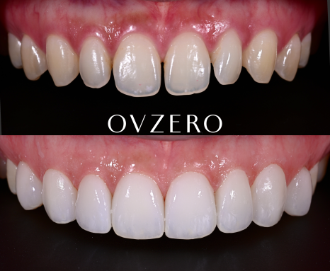 Objeo Laminate Price, and How It Differs from No-Prep Laminate image 4