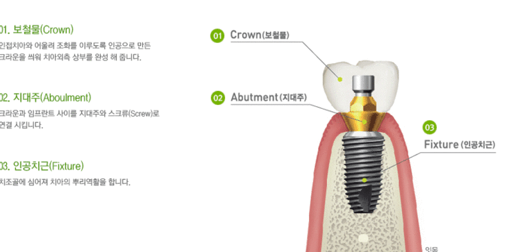 No Problem Even for Implants from Another Clinic! If You Only Need Screw Hole Filling, Seoul Of Dental Hospital Can Help🛠️ image 1