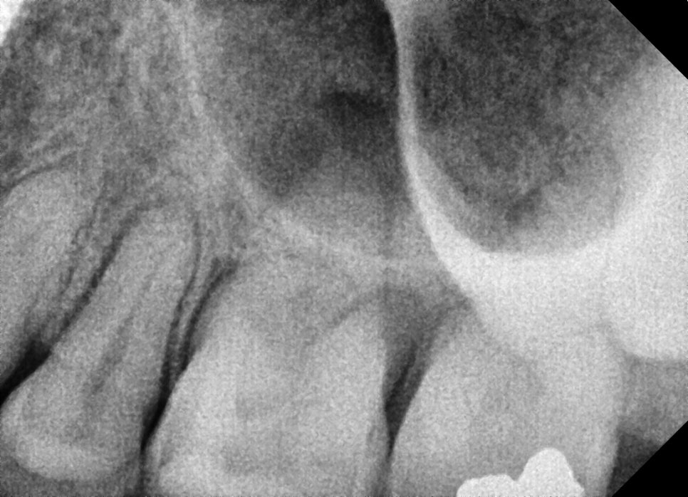 어금니 임플란트가격, 임플란트치과에서 진행한 실제 치료 과정 관련 이미지 10