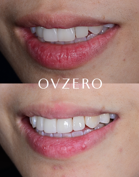 Laminate Veneers for Protruding Teeth: If They’re Too Thick, They Look Even More Prominent image 16