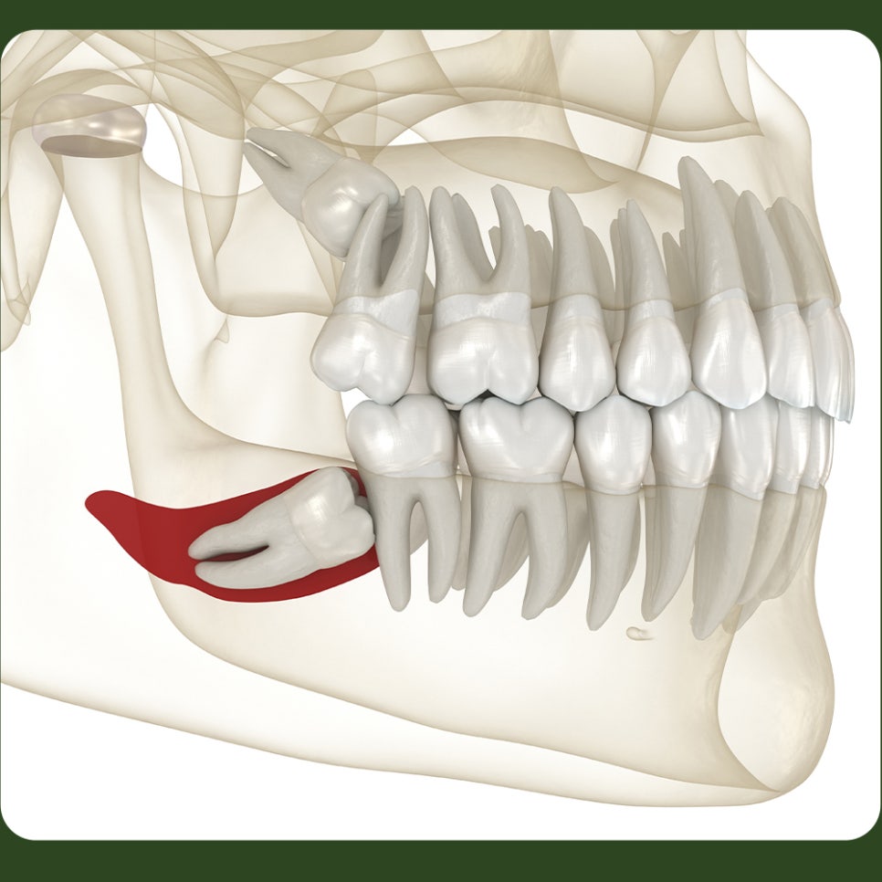 After Wisdom Tooth Extraction, How Long Should You Keep Biting on the Gauze? image 3