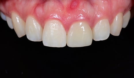 Rabbit Teeth Veneers: Treatment to Achieve Natural Front-Tooth Proportions image 3