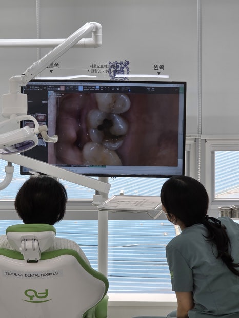 When a molar breaks, do you always need an implant? image 4