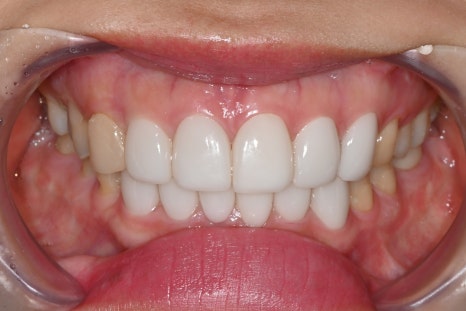 Can a laminate veneer received at another clinic be redone? image 1