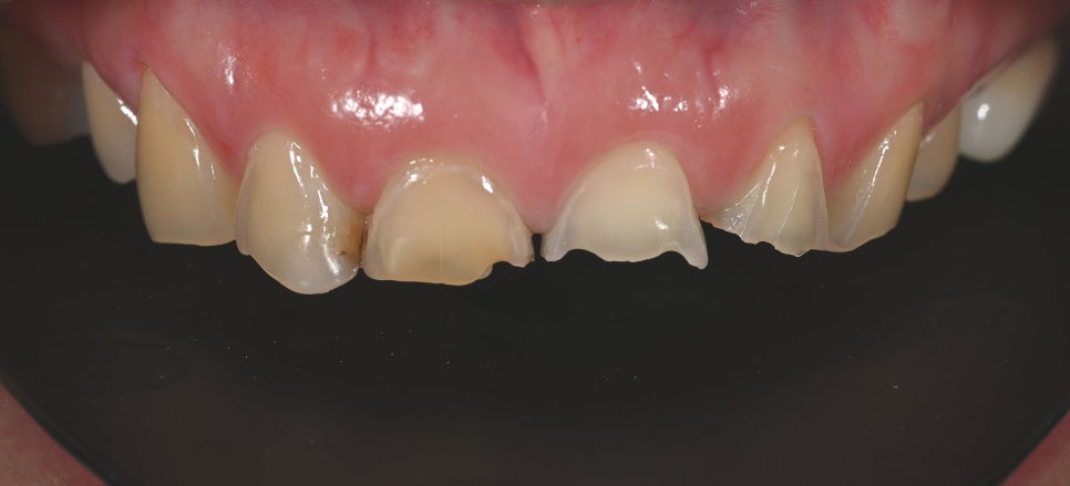 Treatment with Objetto Laminate Veneers After a Chipped Front Tooth image 10