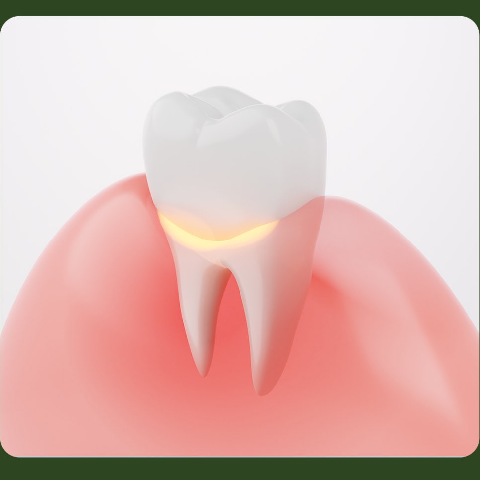 What Causes Tooth Notching, and How Is It Treated? image 2