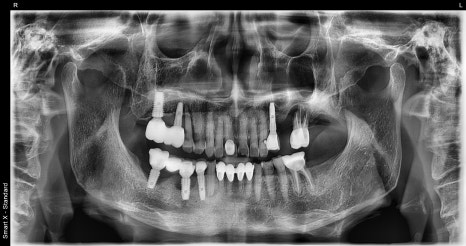 Implants Possible Even in Your 90s: Real Cases from Seoul Above Dental Clinic! image 1