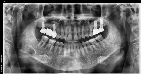 Don’t wait after extraction—place it right away! The golden time when bone comes back to life image 5