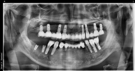 Immediate Implant Placement After Extraction! Seoulove Dental’s Fast Full-Mouth Implant Treatment Completed in 4 Months image 1