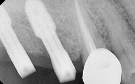 Songpa-gu Dental Clinic: Solving a Case Where Prosthetics Were Impossible with Implant Reoperation! image 9