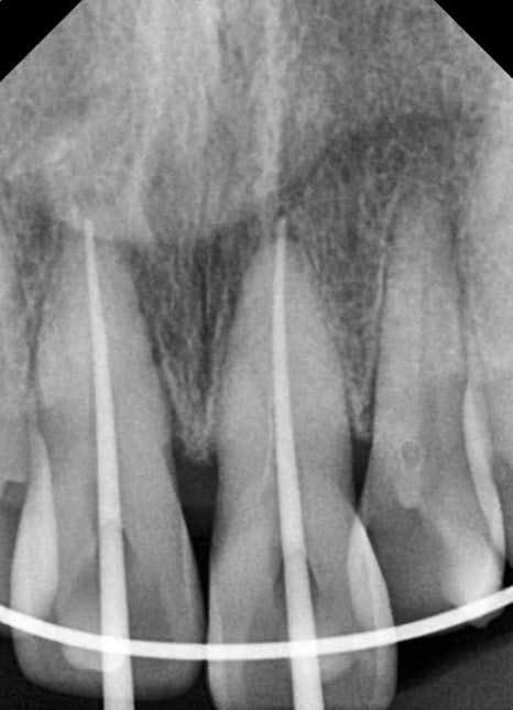 Treatment Process Revealed for a Fall That Injured Both the Front Teeth and Lip image 17