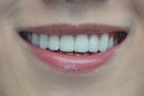 The Real Reason for the Price Difference in Laminates: See for Yourself with OVZERO Minimally Prepared Veneers image 17