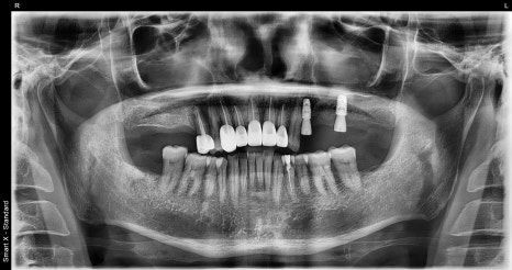A Broken Front Tooth from a Fall, Restored Along with the Gums! Emergency Treatment Report from Seoul Ob Dental Hospital image 7