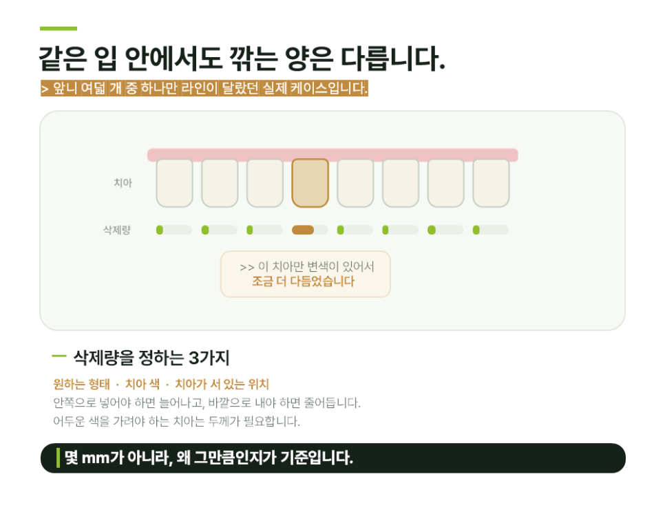 앞니 라미네이트 치아삭제, 최소삭제는 어디까지 가능할까요 관련 이미지 8