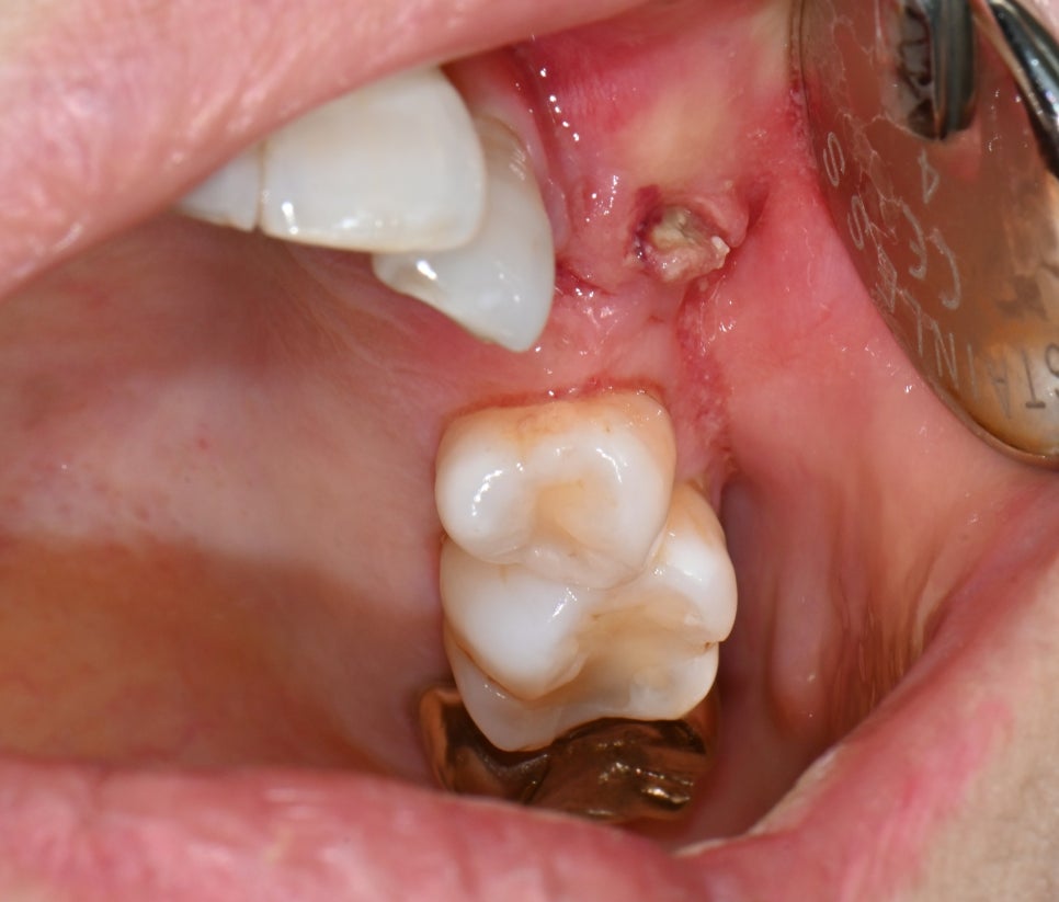 Songpa-gu Front Tooth Implant: Is It Possible Even in an Inflamed Area? image 2
