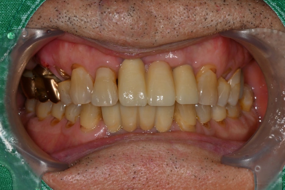 Songpa Dental Clinic: Man in His 70s Fell on Sidewalk Blocks, Requiring Laceration Suturing and Implant Surgery image 13