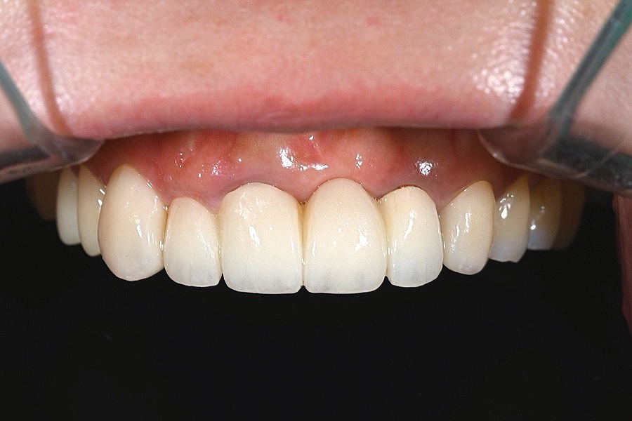 오브제로라미네이트, 무삭제라미네이트 자연스럽게 가능할까?(OVZERO Veneers, Is No-Prep Veneer Really Possible?) 관련 이미지 15