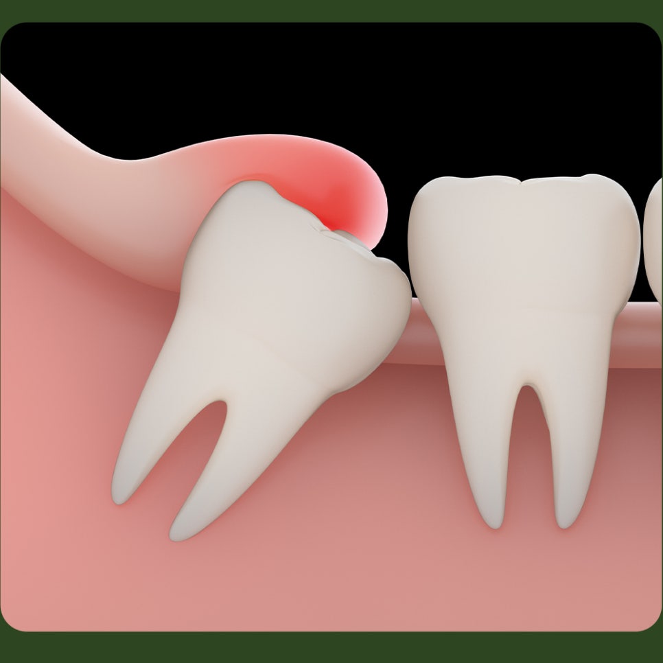 Can I Drink Alcohol After Wisdom Tooth Extraction? image 3