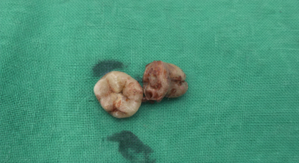 Jamsil Wisdom Tooth Extraction: If It Doesn’t Hurt, Is It Okay to Keep Putting It Off? image 17