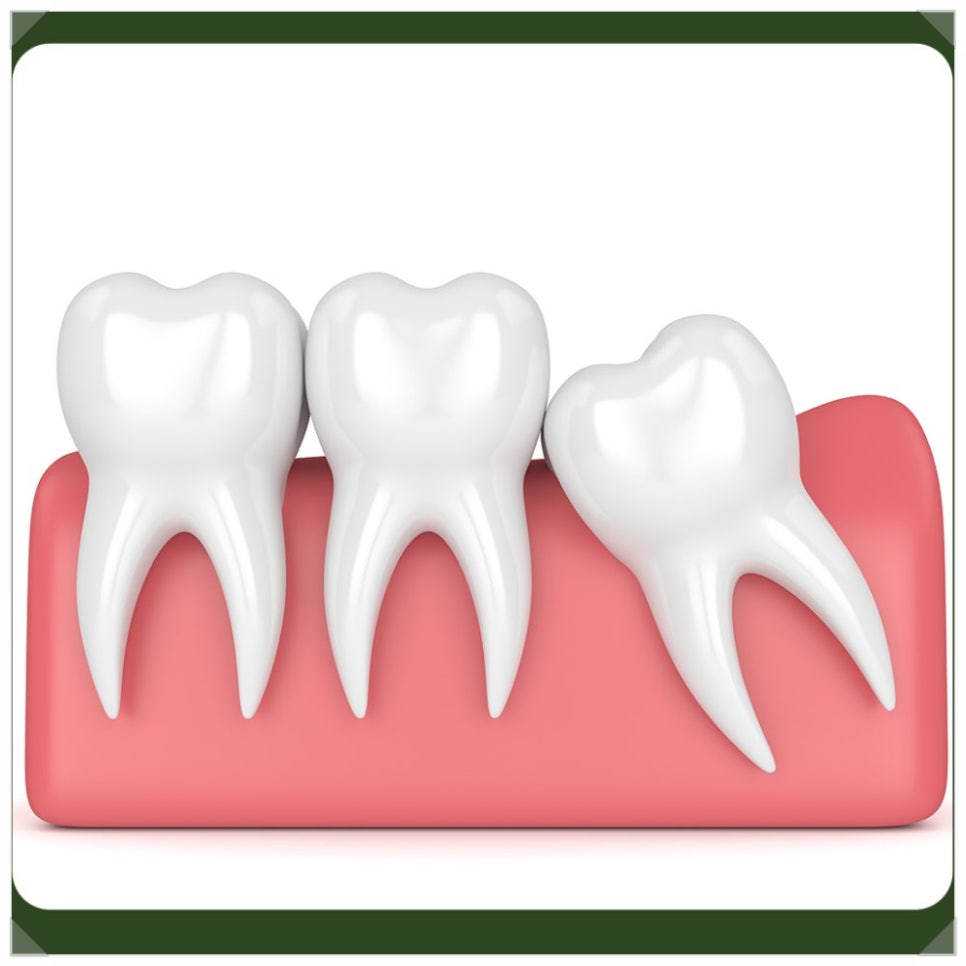 Pain After Wisdom Tooth Extraction: If It’s Getting Worse, Please Read This! image 4