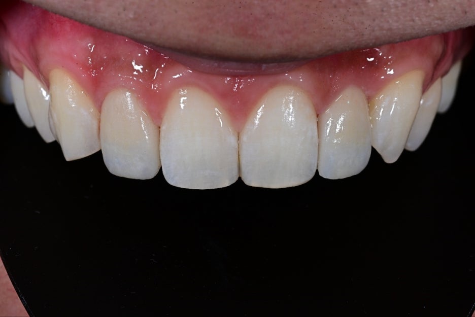 Object Zero Front Tooth Laminate, Minimizing Tooth Reduction image 27