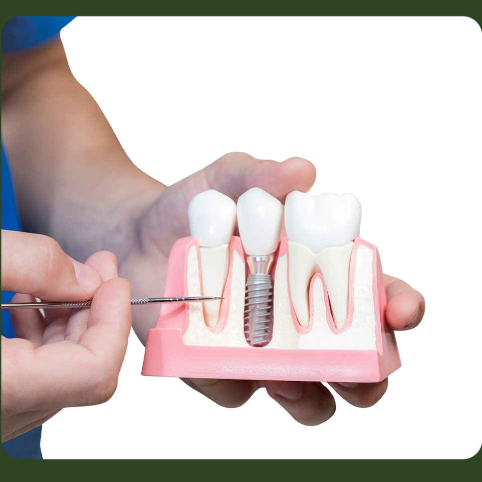 Implants for Those Aged 65 and Over: Are You Eligible? image 5