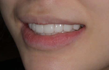 Canine Veneers Without Orthodontic Treatment image 14