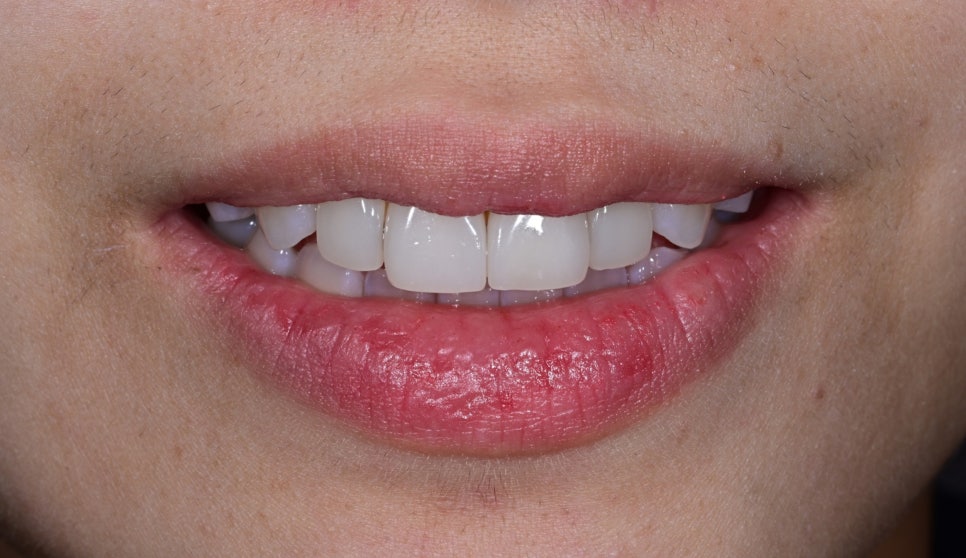 Laminate Veneers for Protruding Teeth: If They’re Too Thick, They Look Even More Prominent image 1