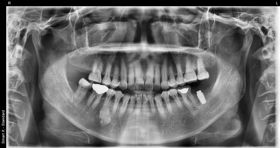 Sammyeon Station Dental Clinic Molars Implant Price, Treatment Process from Extraction to Prosthetics image 7