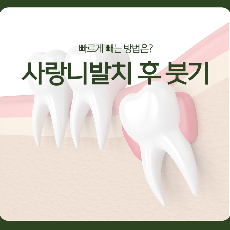 Swelling After Wisdom Tooth Extraction: How Can You Reduce It Quickly? image 1