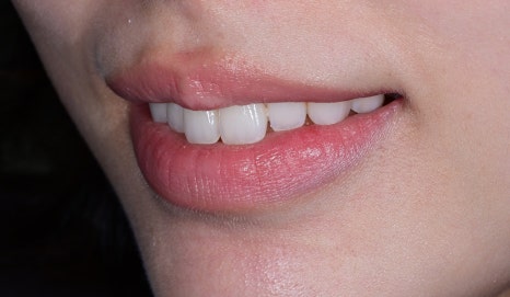 Canine Veneers Without Orthodontic Treatment image 8