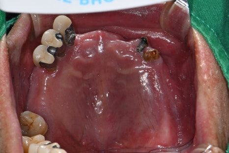 If Your Denture Keeps Coming Loose, What Should You Do? A Real Case Solved with Insurance-Covered Implant Dentures image 4