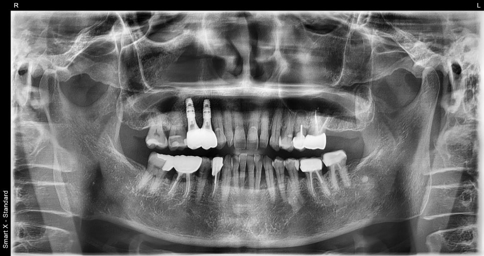 Is an Implant Price Really Worth Trusting? image 19