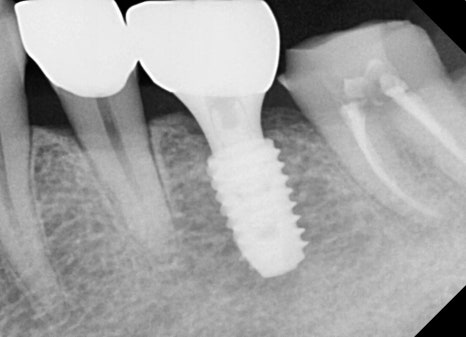 Are you afraid of the dentist? With sedation treatment, you can get root canal treatment and implant surgery without worry! image 4