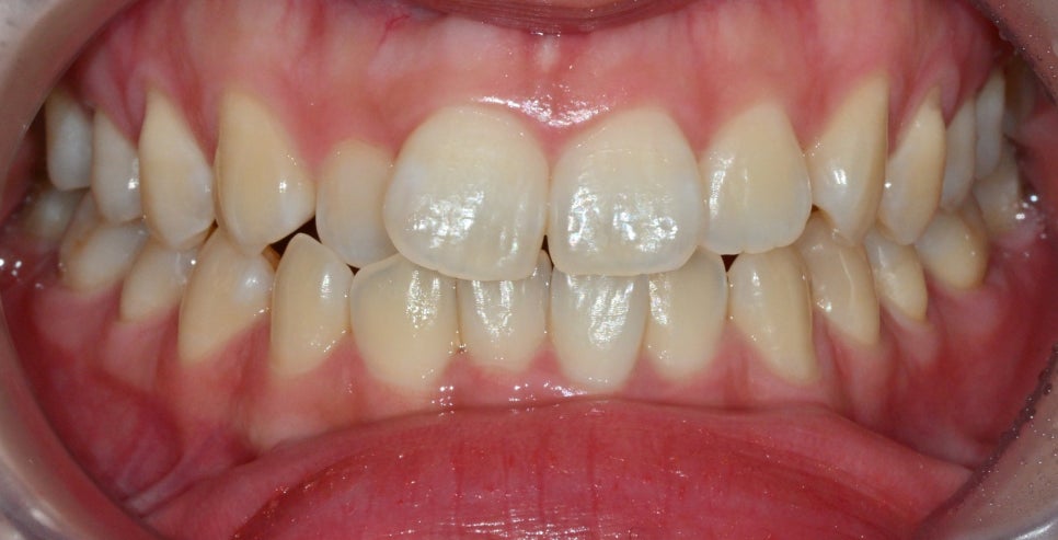 Why the Front Teeth Laminate Changed Naturally with Obzero Laminate image 11