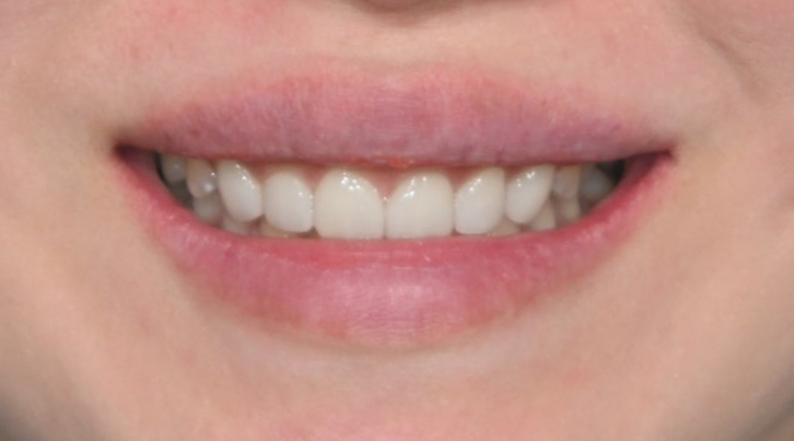 Can Gaps Between the Front Teeth Be Treated with Composite Resin? A Case Treated with Veneers image 10