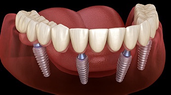 When Can You Smoke After an Implant? image 1