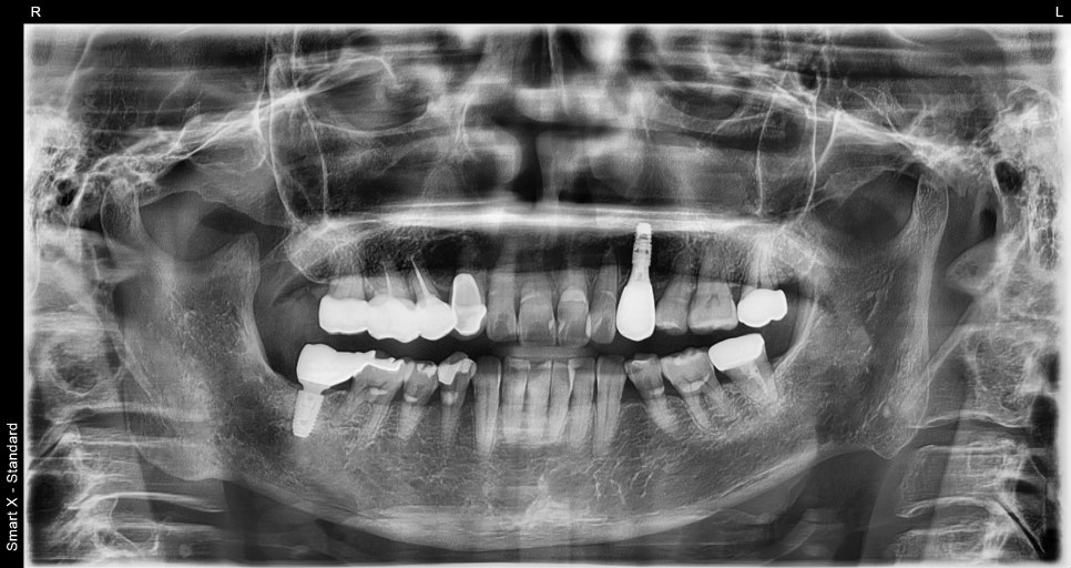 Songpa-gu Front Tooth Implant: Is It Possible Even in an Inflamed Area? image 9