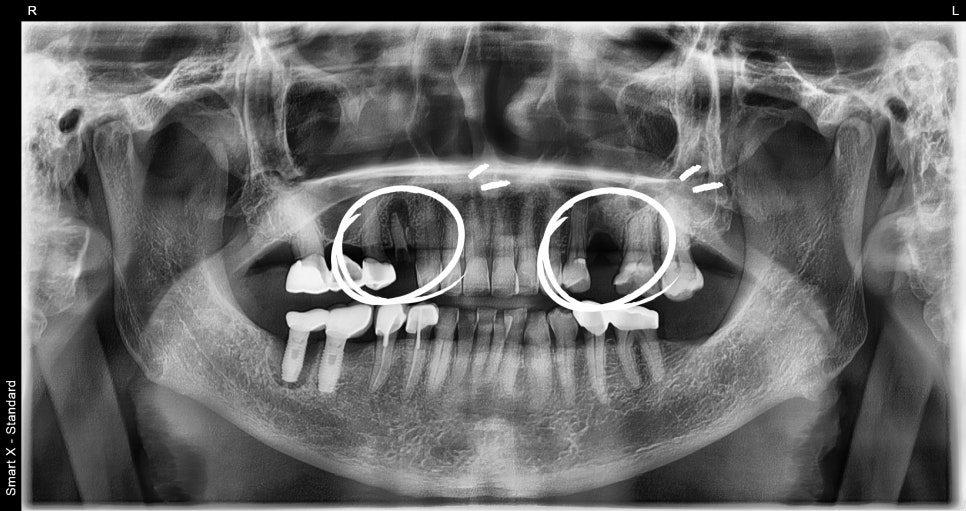 A Surgical Case of a Male Patient in His 70s Restoring Healthy Eating Habits with Insurance-Covered Implants image 1