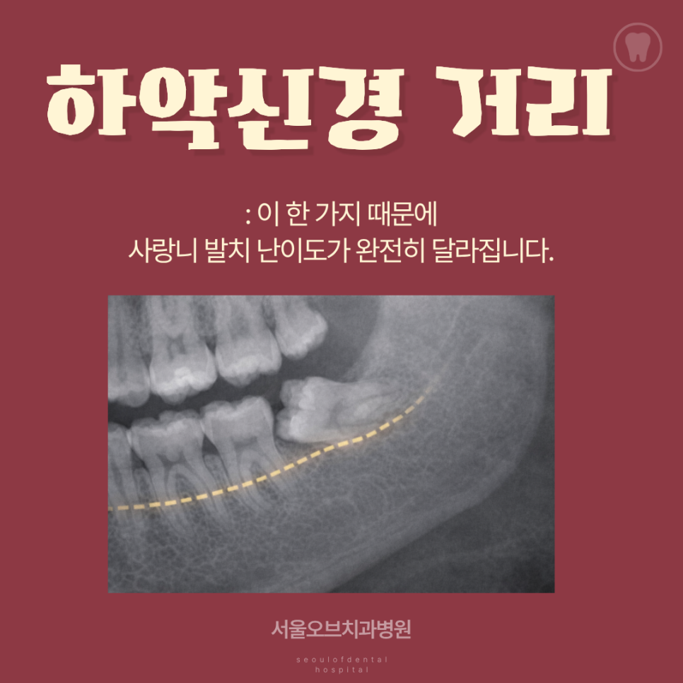 Jamsil Wisdom Tooth Extraction: If It Doesn’t Hurt, Is It Okay to Keep Putting It Off? image 18